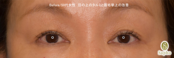 目の上のたるみとり 眉下切開 眉下リフト 美容整形 美容外科サフォクリニック 東京 六本木