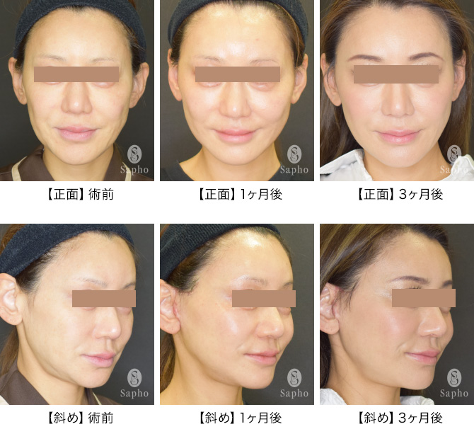 アングルフェイスリフト|美容整形・美容外科サフォクリニック(東京 六本木)