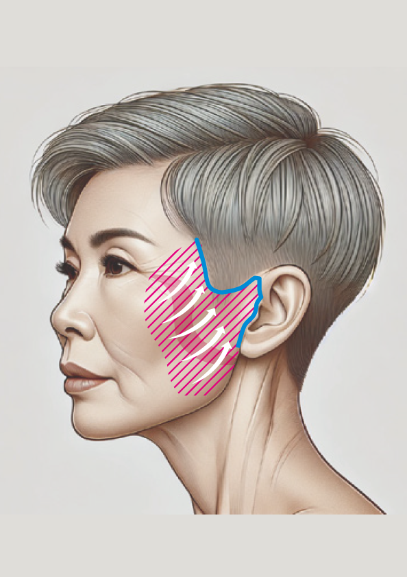 フェイスリフト