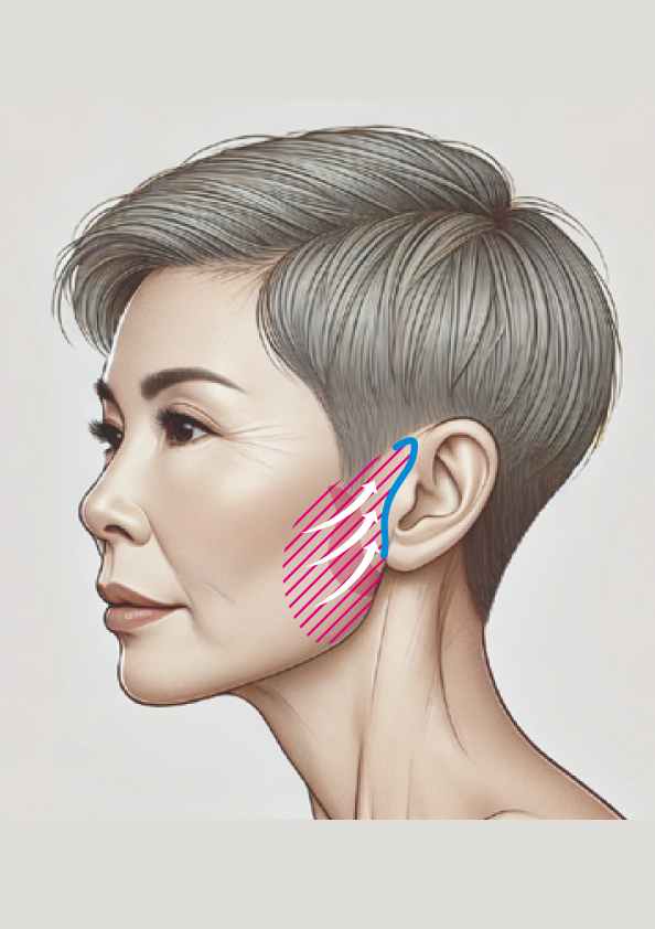 サフォオリジナル ミニリフト